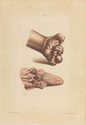  Hand-colored lithography on paper by an unknown lithographer featuring two medical illustrations. The top image shows a hand with anesthetic leprosy, and the bottom image depicts a tongue with epiglottis and part of the larynx affected by nodular leprosy, both rendered in detailed brown tones on a beige background.