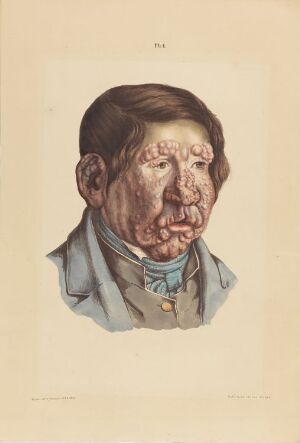  A hand-colored lithograph on paper by an unknown lithographer, showing a portrait of a thirteen-year-old boy with a medical condition characterized by a large number of nodules covering his face, wearing a blue shirt and teal cravat on a cream-colored background. The title is "En tretten år gammel gutt med fullstendig utviklede knuter."