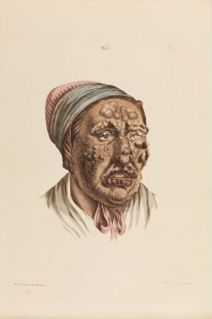  Hand-colored lithograph on paper titled "En 28 år gammel pike med konfluerte knuter som er dekket med tykke, gråbrune skorper" by an unknown lithographer, depicting a young woman with a serious skin condition, wearing a traditional headdress, against a plain cream background.