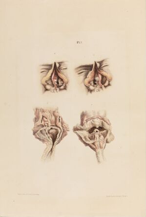  Hand-colored lithograph on paper titled "En gjennomskåret nese; åpnede struper" by Johan Ludvig Losting, featuring detailed medical illustrations of the cross-sections of the human nose at the top and views of the opened throats at the bottom, colored in realistic flesh tones and deep reds to depict the intricate anatomy.