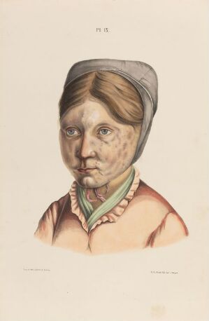  Hand-colored lithograph on paper by an unknown lithographer depicting a fourteen-year-old girl with a pale and patchy complexion indicative of leprosy. She wears a gray headscarf, a green checkered collar, an orange-brown attire, and a red and green striped scarf. Her expression is solemn with a soft, direct gaze. The artwork is titled "En fjorten år gammel pike som er rammet av spedalskhet."