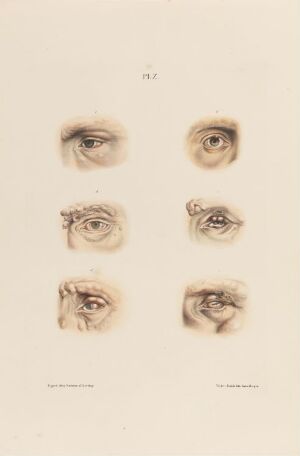  Hand-colored lithograph on paper titled "Øye som er rammet av knutet spedalskhet" by an unknown lithographer, depicting six detailed illustrations of human eyes with various stages of a nodular disease, using natural flesh tones and subtle shading to convey