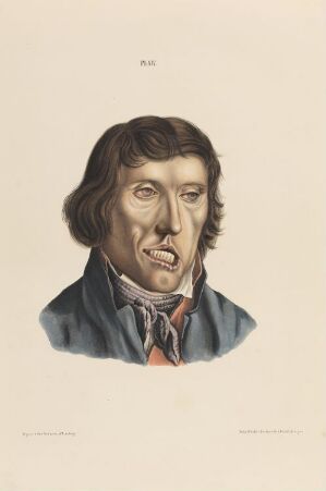  A hand-colored lithograph by an unknown artist titled "28 år gammel mann som er rammet av spedalskhet" depicting the solemn head and shoulder portrait of a 28-year-old man showing the effects of leprosy, against a plain cream background. The colors are muted with attention to the historical clothing in blue and red, and detailed depiction of the man’s facial features affected by the disease.