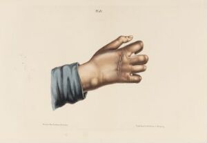  Hand-colored lithograph on paper by an unknown lithographer, titled "Hånd som er rammet av spedalskhet," depicting a human hand and part of the forearm affected by leprosy with a piece of blue fabric around the wrist, against a neutral beige background.