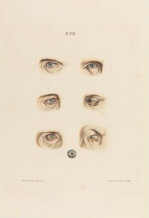  An illustration titled "Stadier i utviklingen av spedalskhet i øyet" by an unknown lithographer, depicting seven eyes on