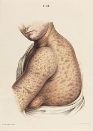  "Tyve år gammel kvinne" by unknown lithographer is a hand-colored lithograph on paper, presenting a detailed depiction of a young woman's torso with a skin condition, composed in natural tones against a soft backdrop.