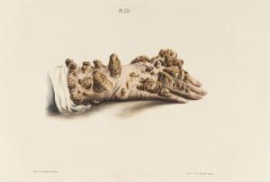  A hand-colored lithograph on paper titled "Hånd som er rammet av spedalskhet" by an unknown lithographer, depicting a detailed, disfigured human hand with swollen fingers and lesions, indicative of leprosy, against a blank background with a fold of white fabric at the wrist.