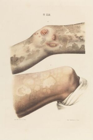  Hand-colored lithograph on paper by an unknown lithographer titled "Ben som er rammet av spedalskhet," showing detailed depictions of a leg and a forearm affected by leprosy, with discolored skin, lumps, and lesions visible against a plain background.