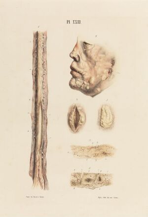  "Ansikt og spiserør som er rammet av spedalskhet" by Johan Ludvig Losting is a hand-colored lithograph on paper featuring anatomical illustrations that detail the effects of leprosy on a human face in profile and an esophagus, with additional close-up studies of tissue below. The muted color palette displays the damage caused by the disease with precise detail and a somber aesthetic.