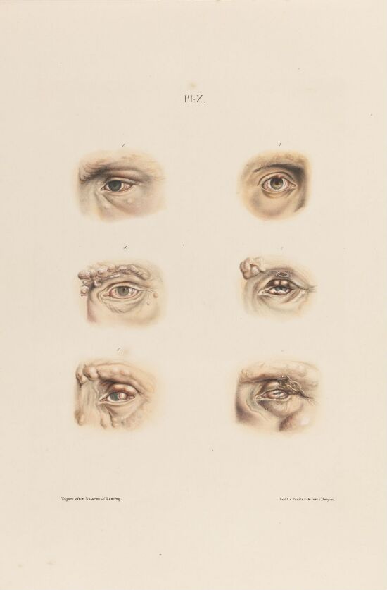 Øye som er rammet av knutet spedalskhet