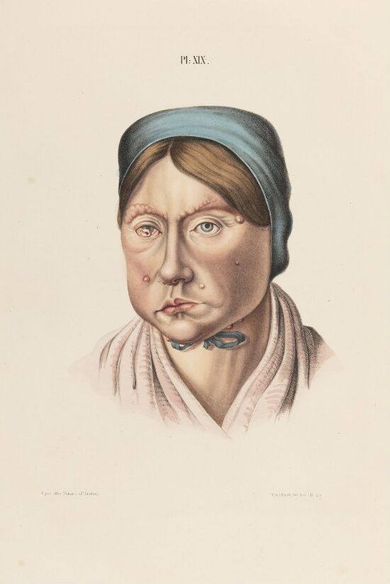 26 år gammel kvinne som er rammet av spedalskhet